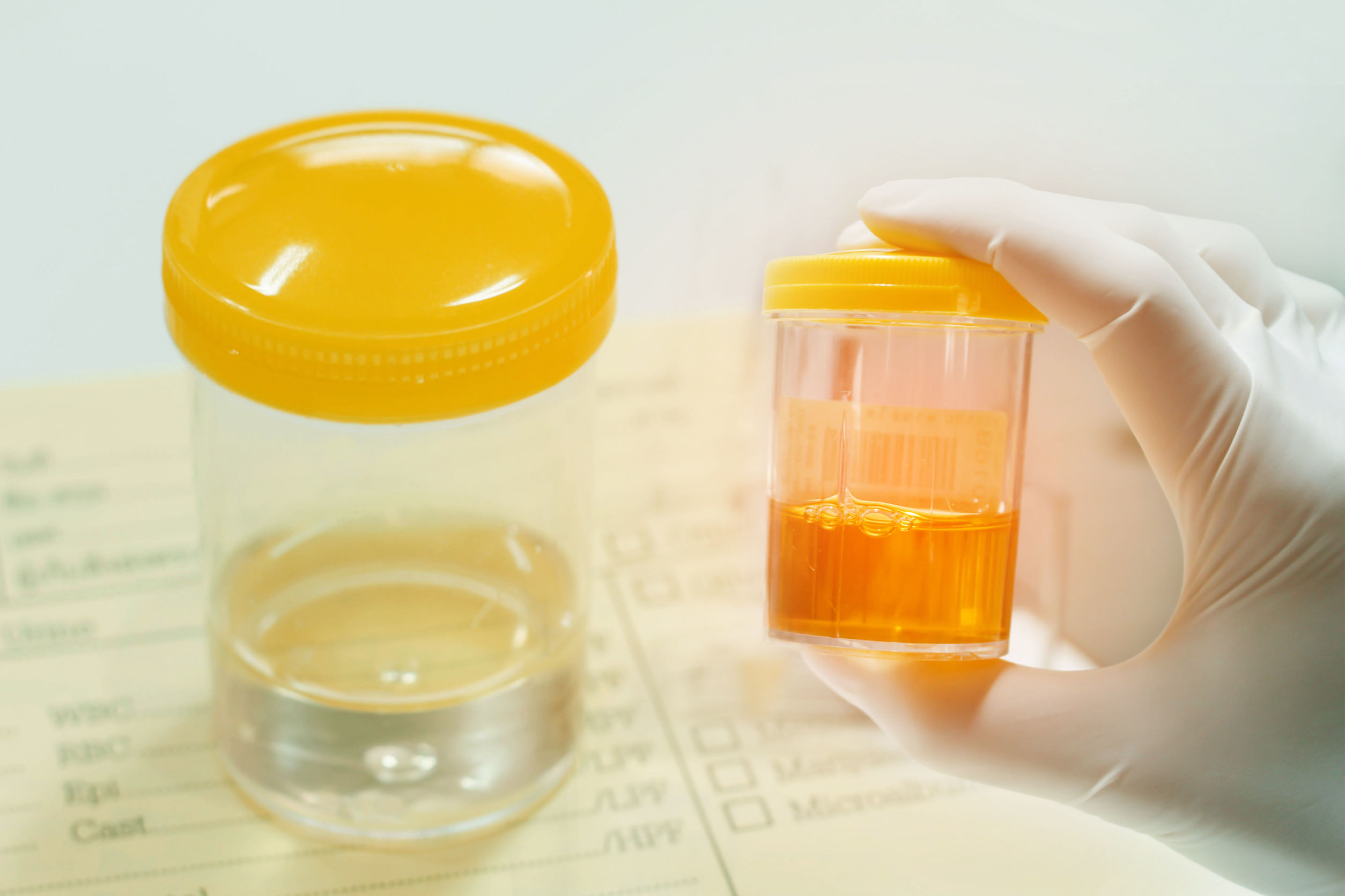 Urine Drug Testing vs. Oral Fluid Testing: Which Is the Best Choice for Employers?